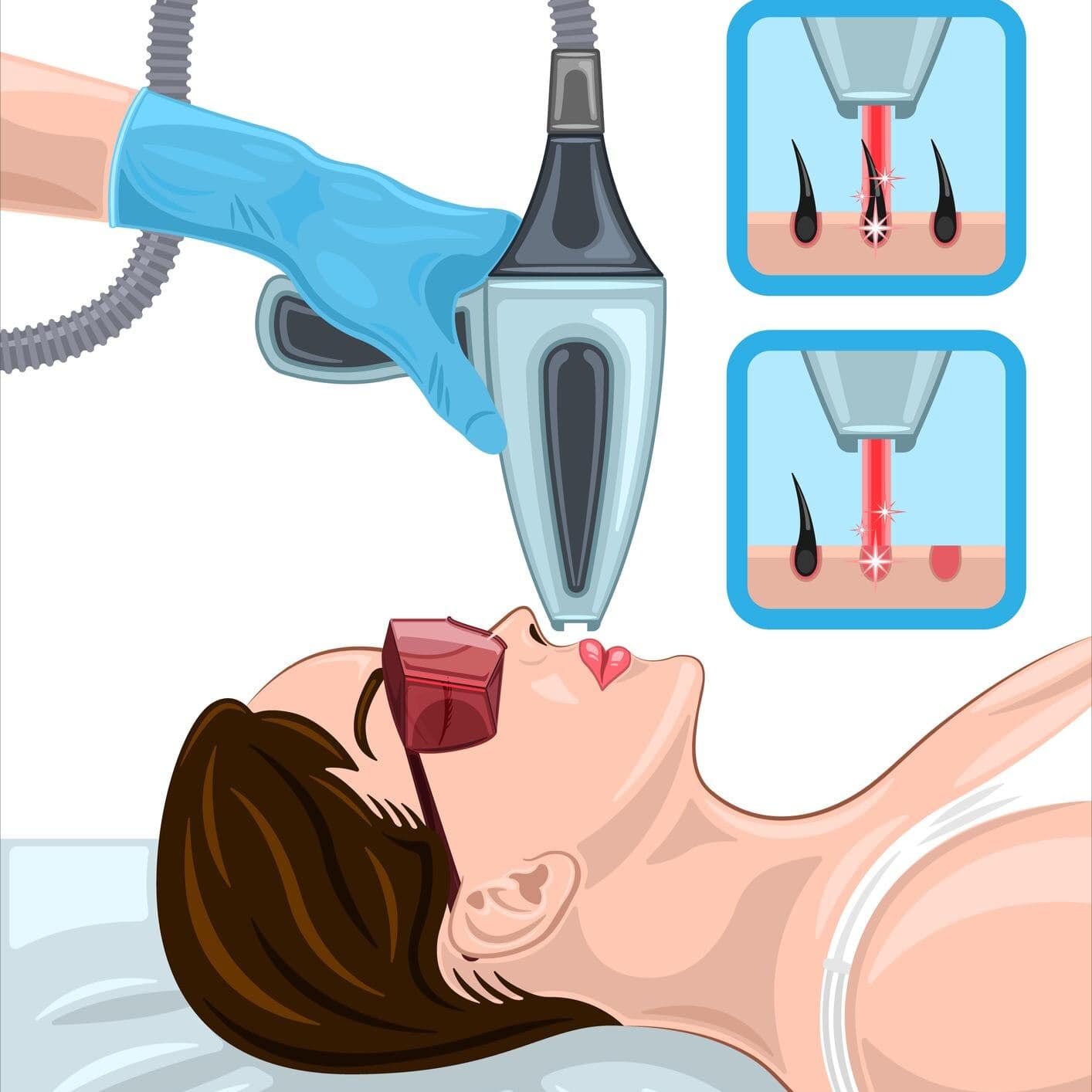 إزالة الشعر بالليزر
