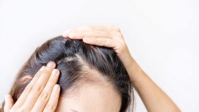 تساقط الشعر الوراثي عند النساء - بنات طب